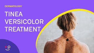 How To Treat Tinea Versicolor [upl. by Cire]