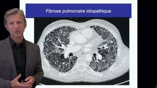 ECN PID cours 2 Fibrose pulmonaire idiopathique DFASM1 Pr V Cottin Lyon [upl. by Newman]