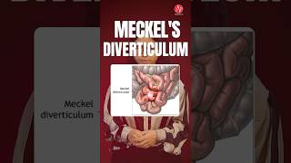 Mnemonics of Meckels diverticulum by Ms Chitra Pandey  NORCET 70 amp 80  Nursing Next Live [upl. by Sells]