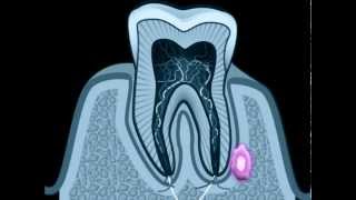 Cisti dentale  cisti radicolare [upl. by Ecnar867]