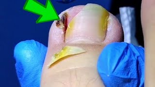 Toenail Turns Yellow After Infection Huge Ingrown Toenail Removal [upl. by Adala971]