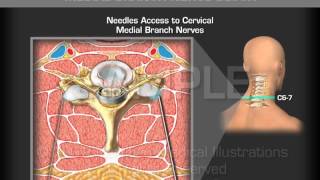 Image Guide Cervical Medial Branch Nerve Block [upl. by Keynes]