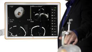 RealTime Updates with Brainlab Ultrasound Integration [upl. by Leunas606]