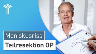 Meniskus OP Meniskusriss arthroskopisch behandeln  Teilresektion [upl. by Ciapas135]