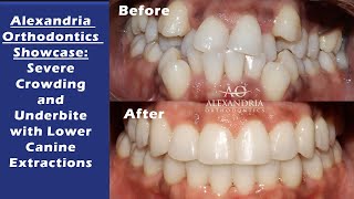 Alexandria Orthodontics Showcase Severe Crowding and Underbite with Lower Canine Extractions [upl. by Asilram]