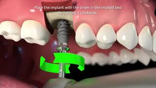 Straumann® TLX Implant System Step by Step [upl. by Hiro]