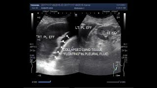 Ultrasound Video showing bilateral pleural effusion [upl. by Rowell514]