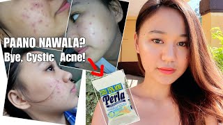 How I Get Rid My Acne  Perla Soap PHILIPPINES Tagalog [upl. by Rives]