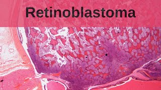 Retinoblastoma  Pathology mini tutorial [upl. by Zacharias]