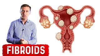 The Best Foods to Shrink Fibroids [upl. by Dimah]