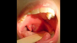 PERITONSILLAR ABSCESS [upl. by Oniger]