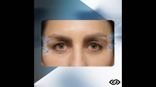 🌟 Procedimiento Lifting endoscópico de cejas MIVEL [upl. by Siroved]