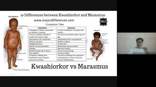 MARASMUS  CAUSES  SYMPTOMS  DIAGNOSIS  TREATMENT  MALNUTRITION IN CHILD in hindi [upl. by Raines]