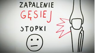 BÓL KOLANA Zapalenie gęsiej stopki [upl. by Eckel]