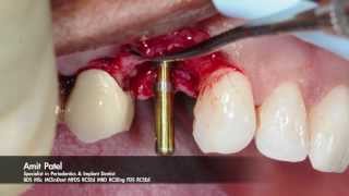 Onestage surgery using Tapered Internal PLUS dental implant from BioHorizons [upl. by Aldos350]