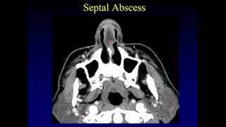 Imaging of the Paranasal Sinuses 3 [upl. by Kelsy]