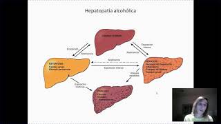 Hepatopatía alcohólica [upl. by Schluter]