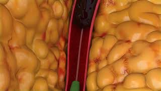 Peripheral Thrombectomy Animation [upl. by Neukam]