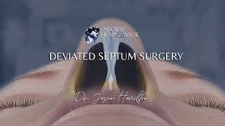 Deviated Septum Surgery [upl. by Green]