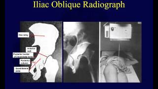 Acetabular Fracture Radiographic Evaluation  Everything You Need To Know  Dr Nabil Ebraheim [upl. by Aholla497]