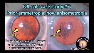 CataractCoach 1616 IOL calc case study 7 prior emmetropia [upl. by Antoni]