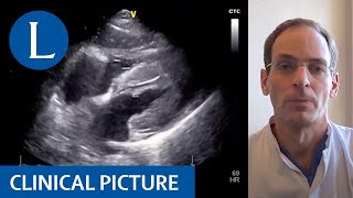 Myocarditis in a patient with COVID19 [upl. by Leahey]