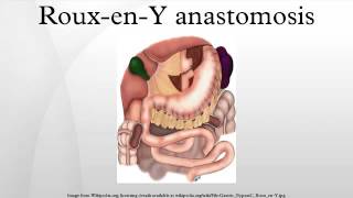 RouxenY anastomosis [upl. by Pansie]