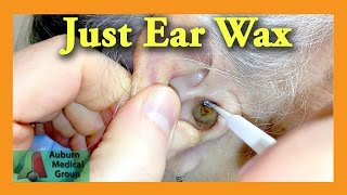 Ear Wax Removal Doctor  Auburn Medical Group [upl. by Jackquelin]