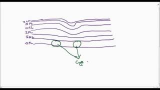 cystoid macular edema [upl. by Alimrahs]