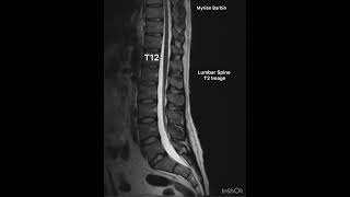 MRI Lumbar Spine anatomy diagnosticradiology mri [upl. by Selwyn216]