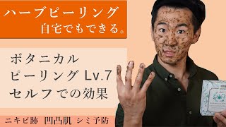 ハーブピーリングをセルフで実践🍁 ボタニカルピーリング レベル７の使い方と効果とダウンタイムについて。 [upl. by Sarah]