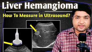 Hemangioma liver ultrasound in hindiUrdu  How to Measure liver pathology [upl. by Aerbas]