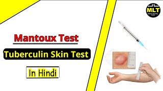 Tuberculin Skin Test  Mantoux test  Procedure amp Principle [upl. by Karsten]