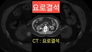 요로결석 CT 진단 결석 요관 ureter stone [upl. by Cherrita353]