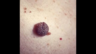 Dysplastic Nevus 5Minute Pathology Pearls [upl. by Ekud]