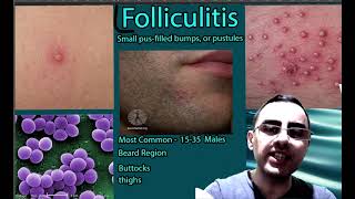 Folliculitis Symptoms causes and treatment [upl. by Ezar]