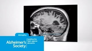 What is posterior cortical atrophy [upl. by Atiz]