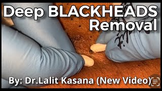 Deep Old Blackhead Removal with Cotton Buds amp Extractor by DrLalit Kasana [upl. by Eisoj]