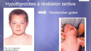 PEDIATRIE Hypothyroïdies de l’enfant [upl. by Annehsat]