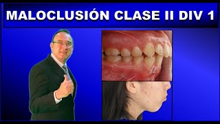 MALOCLUSION CLASE 2 DIVISION 1 DE ANGLE  ORTODONCIA [upl. by Hayman]