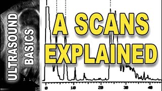 ultrasound  A scans explained [upl. by Ojyllek]