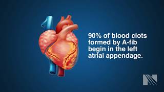 Watchman Procedure for Left Atrial Appendage Occlusion LAAO [upl. by Llebpmac]