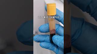 Lipemic serum sample medtech laboratory medtechstudent cls mls lab bloodserum serum lipemia [upl. by Husch]