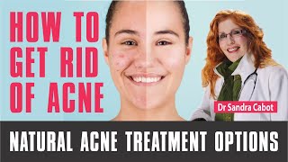 How to get rid of Acne Forever  Acne treatment Options acne acnetreatment [upl. by Azilem]