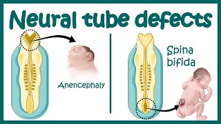 Neural Tube Defect  Overview  signs and symptoms of neural tube defect pathophysiology amp treatment [upl. by Ennazor]