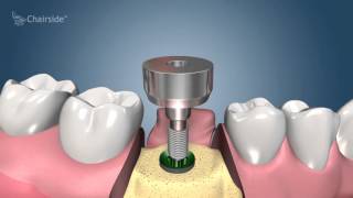 Dental Implant Procedure  Two Stage 🦷 Award Winning Patient Education [upl. by Aneloj500]