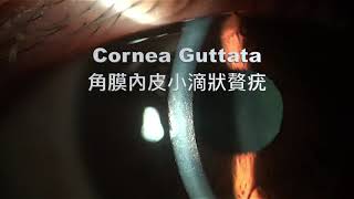 Cornea guttata [upl. by Hardunn255]