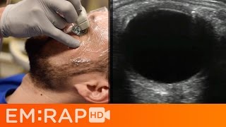 Ultrasound of Retinal vs Vitreous Detachment [upl. by Valdis]