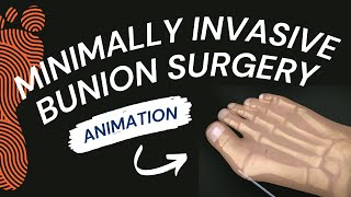 Minimally Invasive Bunion Surgery A Short Animation [upl. by Margaux]