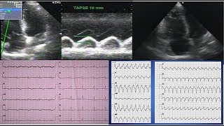 Arrhythmogenic right ventricular cardiomyopathy ARVC or ARVD A case ECG and echocardiography [upl. by Haliek99]